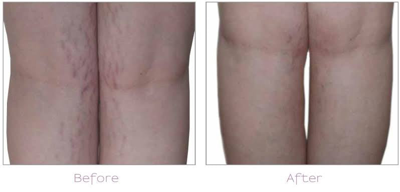 Can Laser Hair Removal Tighten the Skin SKINFUDGE Center of