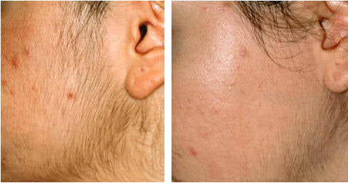 Does Laser Hair Removal Work On Black Hair SKINFUDGE Center