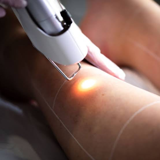 Is laser hair removal permanent or is it temporary SKINFUDGE