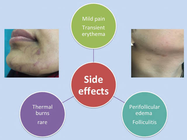 What Are The Side Efects of Laser Hair Removal SKINFUDGE