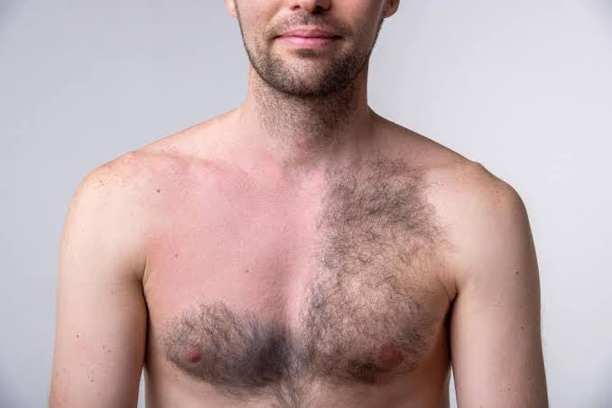 Does laser hair removal work on men Is it permanent SKINFUDGE