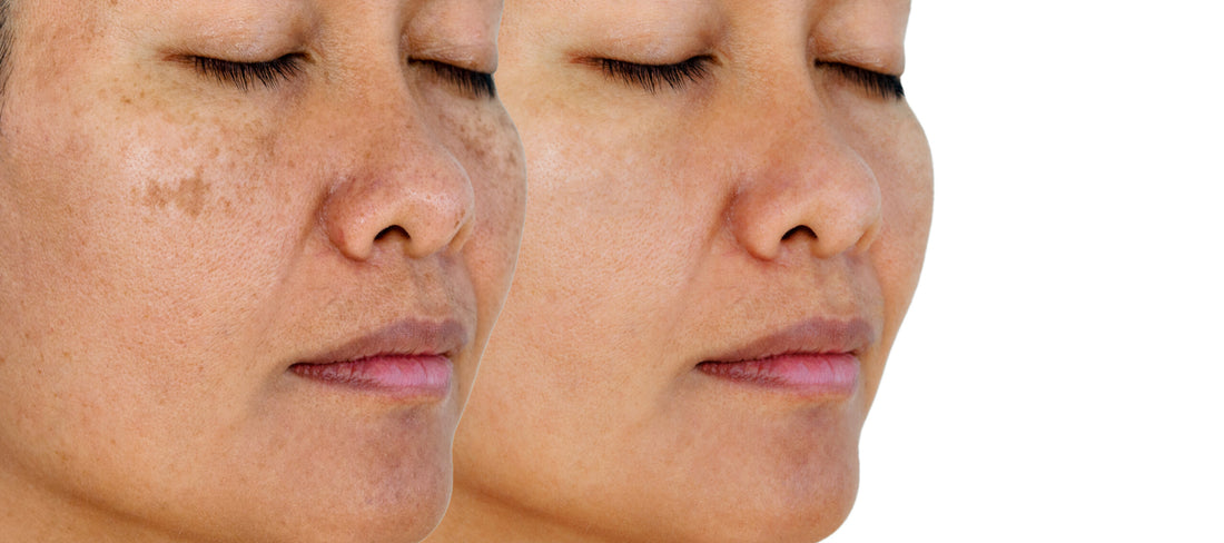Laser Treatment Options For Hyper-pigmented Skin