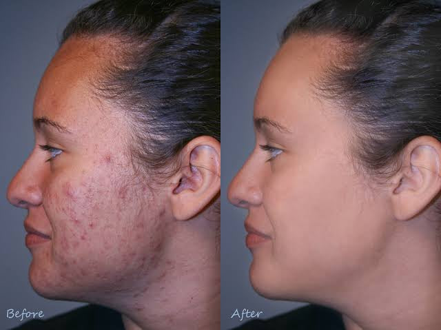 Acne Scar Filler Types And How Long They Last