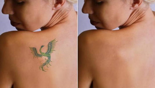 Tattoo Removal Options in Lahore