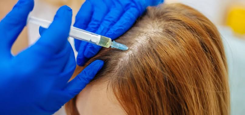 Can PRP / PRF Grow Hair on Bald Scalp? – SKINFUDGE® - Center of Skin ...