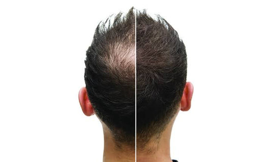 Effect of Adding Biotin To PRP/PRF Session For Hair Regrowth