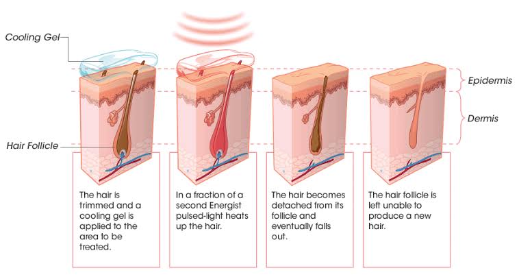 What is The Best Laser Hair Removal Method?