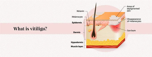 Can You Do Laser Hair Removal If you Have Vitiligo?