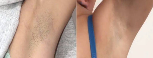 How Long Does Laser Hair Removal Last?