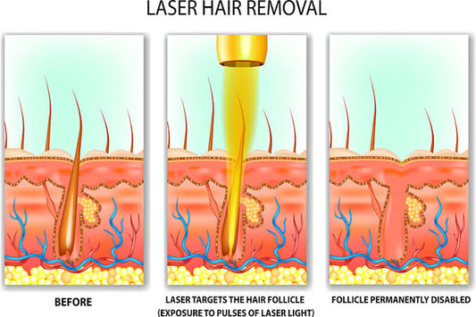 How Does Laser Hair Removal Kill Hair Follicles?