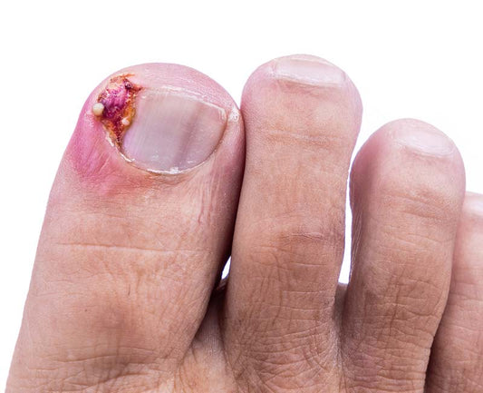 Ingrown Toenail Treatment