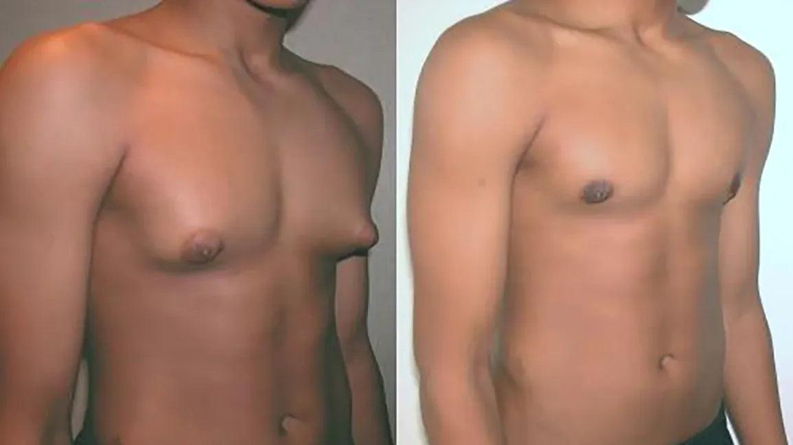 The Ultimate Guide to Gynecomastia Surgery Cost in Pakistan: 5 Key Factors to Consider