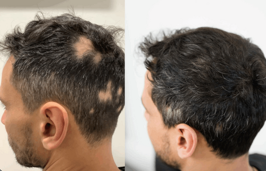 Alopecia Areata Injection - SKINFUDGE® - Center of Skin & Hair Excellence 