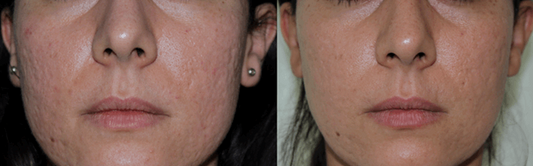 Nano Fat Grafting for Acne Scars (Autologous Fat Grafts) - SKINFUDGE® - Center of Skin & Hair Excellence 