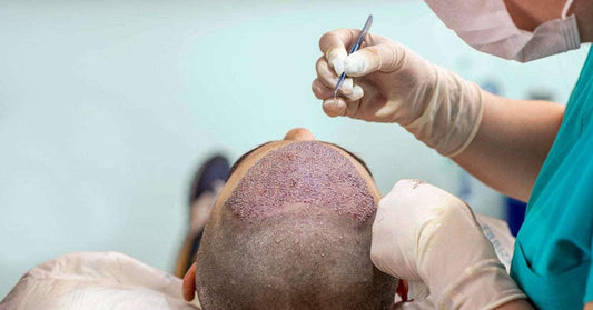 FUE Hair Transplant - SKINFUDGE® - Center of Skin & Hair Excellence 