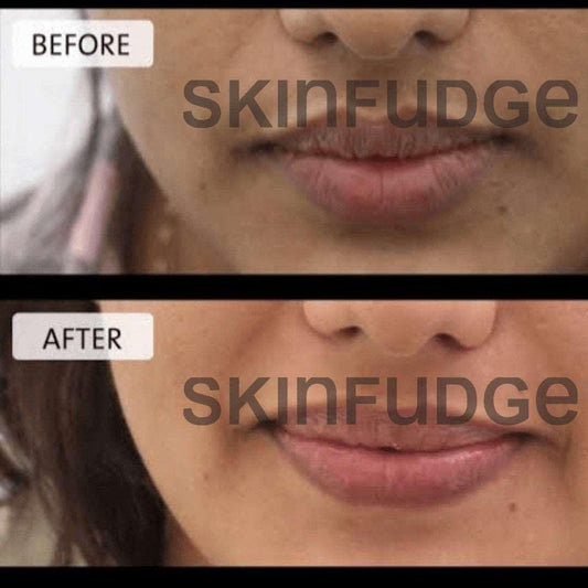 Lip Lightening Procedure - SKINFUDGE® - Center of Skin & Hair Excellence 