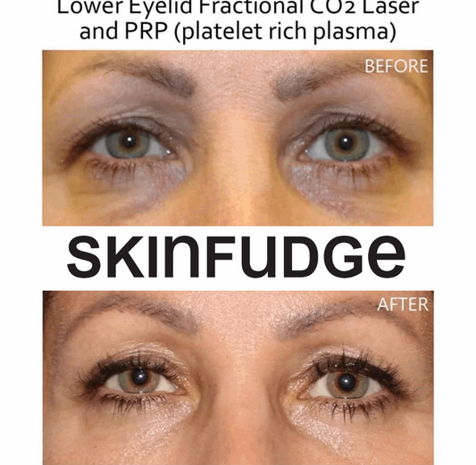 Under-Eye Mesotherapy Treatment - SKINFUDGE® - Center of Skin & Hair Excellence 