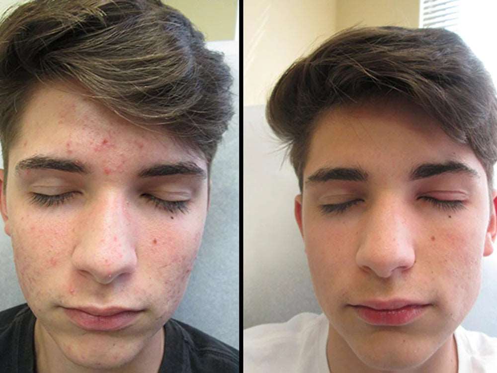 Acne Scars: Treatment Options - SKINFUDGE® - Center of Skin & Hair Excellence 