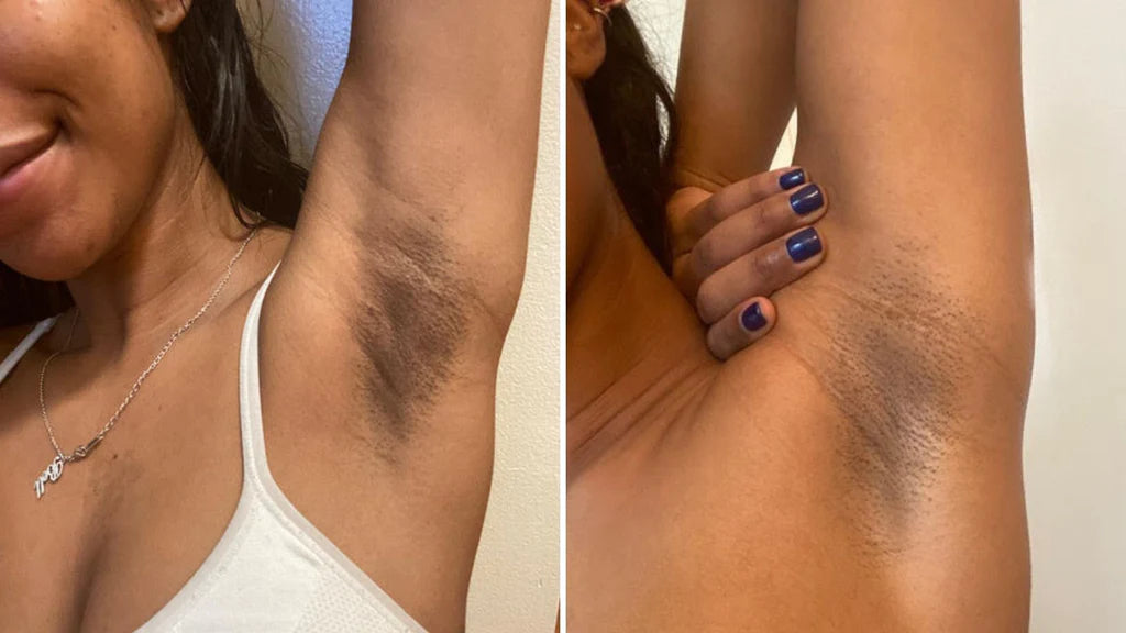 Acanthosis Nigricans - SKINFUDGE® - Center of Skin & Hair Excellence 