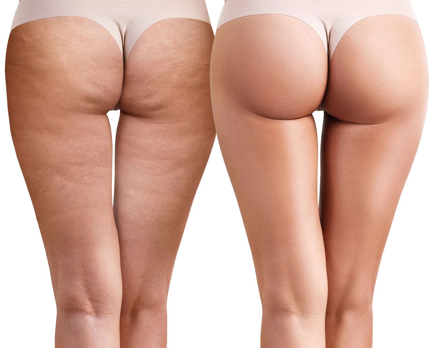 Cellulite Treatment - SKINFUDGE® - Center of Skin & Hair Excellence 