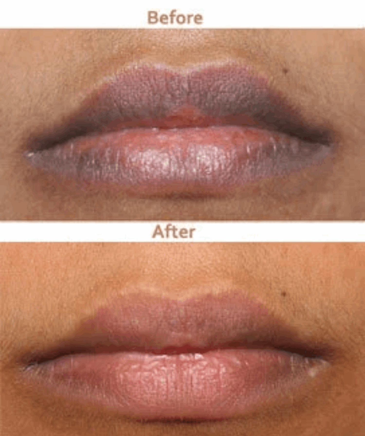 Smoker's Lip Lightening Treatment - SKINFUDGE® - Center of Skin & Hair Excellence 