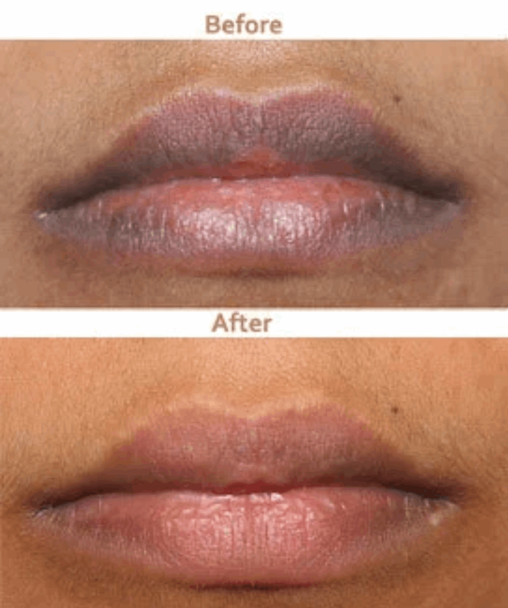 Smoker's Lip Lightening Treatment - SKINFUDGE® - Center of Skin & Hair Excellence 
