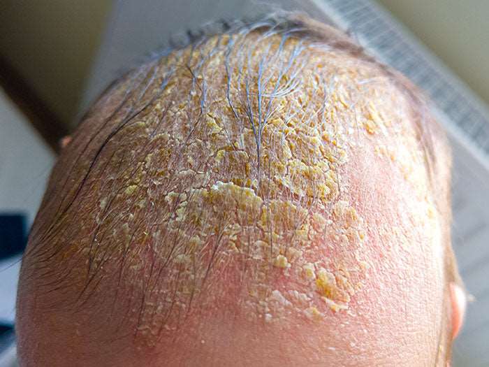 Cradle Cap (Children's Scalp Seborrheic Dermatitis) - SKINFUDGE® - Center of Skin & Hair Excellence 