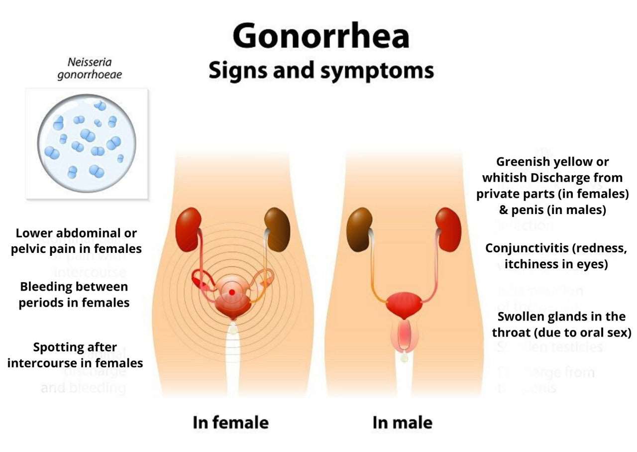 Gonorrhea Treatment Clinic & Cost - SKINFUDGE® - Center of Skin & Hair Excellence 