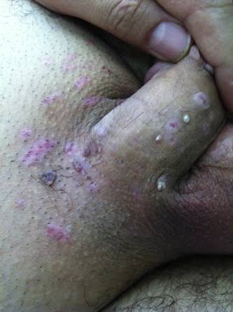 Wart Removal Treatment (Non-Genital)