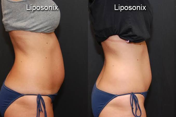 Non-surgical Liposuction (LipoSonix Treatment) - SKINFUDGE® - Center of Skin & Hair Excellence 