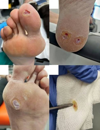 Wart Removal Treatment (Non-Genital)