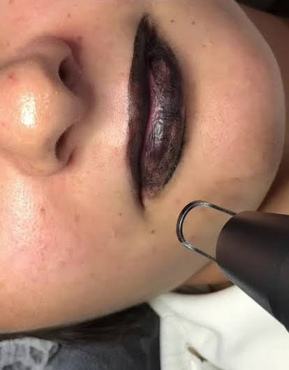 CarboLip: The Black Lip Charcoal Laser Treatment - SKINFUDGE® - Center of Skin & Hair Excellence 