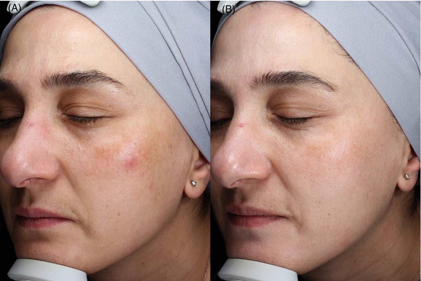 Spectra Peel Laser Treatment - SKINFUDGE® - Center of Skin & Hair Excellence 