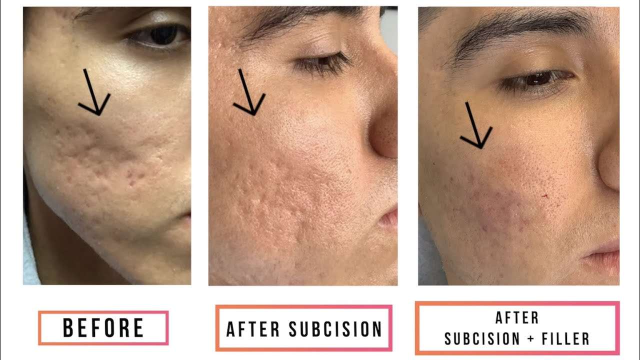 Acne Scars: Subcision - SKINFUDGE® - Center of Skin & Hair Excellence 