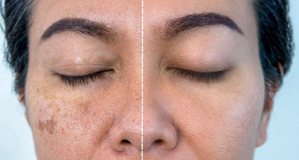 Microneedling (Mesotherapy) PRP Treatment for Face Melasma - SKINFUDGE® - Center of Skin & Hair Excellence 