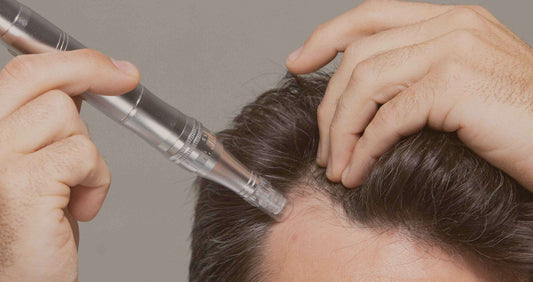 Microneedling (Mesotherapy) Treatment for Scalp - SKINFUDGE® - Center of Skin & Hair Excellence 