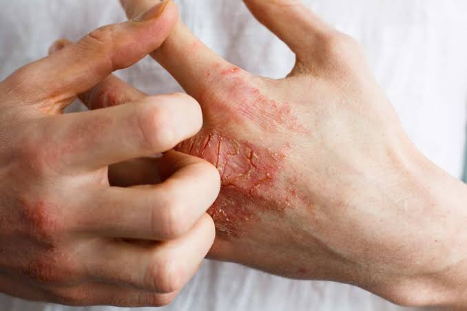 Atopic Dermatitis (Eczema) Treatment