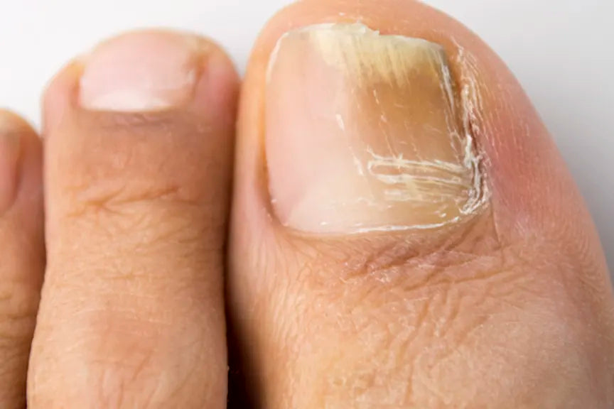 Laser Toe Nail Fungus Removal Treatment - SKINFUDGE® - Center of Skin & Hair Excellence 