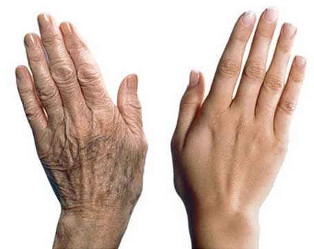 Hand Rejuvenation / Younger Looking Hands - SKINFUDGE® - Center of Skin & Hair Excellence 